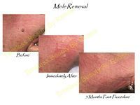 A before and after picture of a mole removal on a person 's arm.