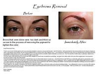A before and after picture of a woman 's eyebrows removal.