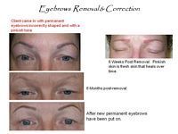 A picture of a woman 's eyebrows before and after eyebrow removal and correction.