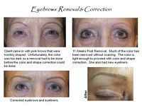 A before and after picture of a woman 's eyebrows removal and correction.