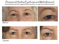 A before and after picture of a woman 's eyebrows and mole removal.