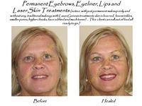 A before and after photo of a woman with permanent eyebrows , eyeliner , lips and laser skin treatments.