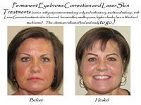 A before and after photo of a woman with permanent eyebrows correction and laser skin.