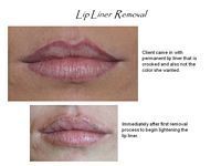 A picture of a woman 's lips before and after lip liner removal.