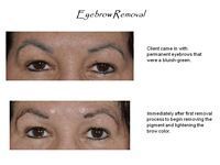 A before and after picture of a woman 's eyebrow removal.