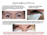 A picture of a woman 's eyebrow removal process.