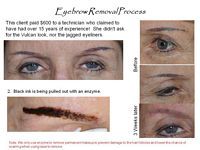 A before and after picture of a woman 's eyebrow removal process.