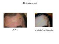 A before and after picture of a mole removal on a man 's forehead.