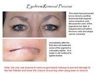 A picture of a woman 's eyebrows before and after eyebrow removal.