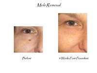 A before and after picture of a woman 's face with a mole on it.