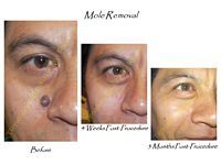 A man 's face before and after a mole removal procedure.
