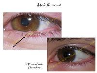 A before and after picture of a mole removal procedure on a person 's eye.
