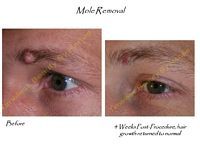 A before and after picture of a mole removal on a man 's eyebrow.