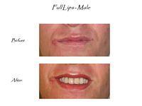 A before and after picture of a woman 's lips.