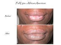 A before and after photo of a woman 's lips.