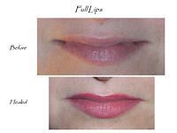 A before and after picture of a woman 's lips.