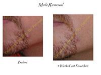 A before and after picture of a mole removal procedure on a man 's face.