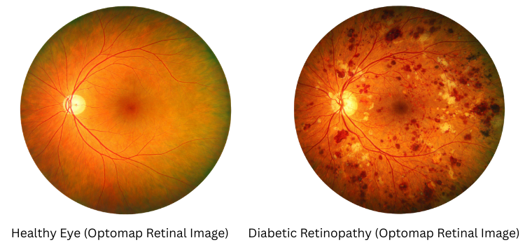 Comparison of healthy eye (left) and eye with diabetic retinopathy (right), both retinal images showing red blood vessels.
