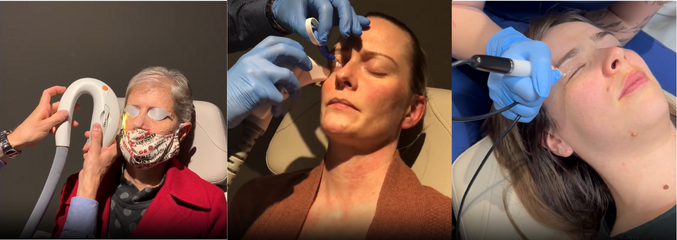 Three medical procedures on faces. From left: Intense Pulsed Light (IPL), Radio Frequency (RF), and Jett Plasma Therapy.