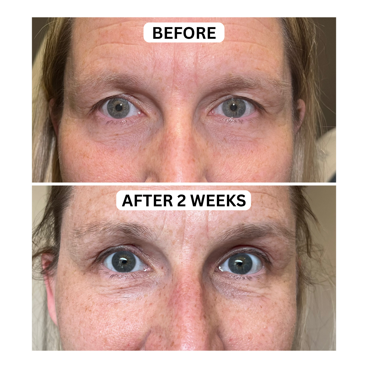 Before-and-after close-up of eyes, showing reduced under-eye circles after 2 weeks.
