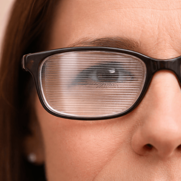 Close-up of a person's eye and nose, wearing eyeglasses with horizontal lines distorting the view.