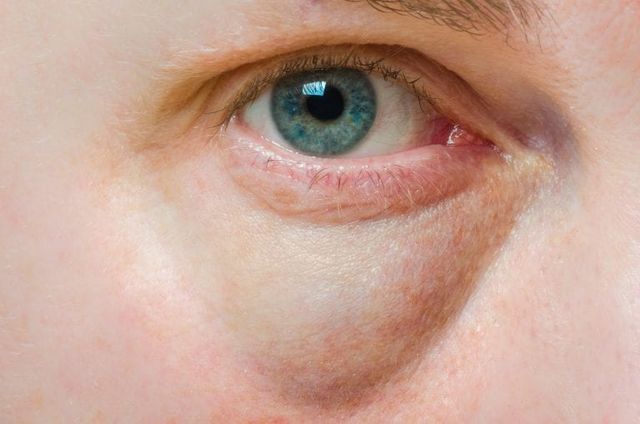 Bags Under the Eyes: What Can You Do About Them?