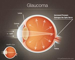 glaucoma graphic