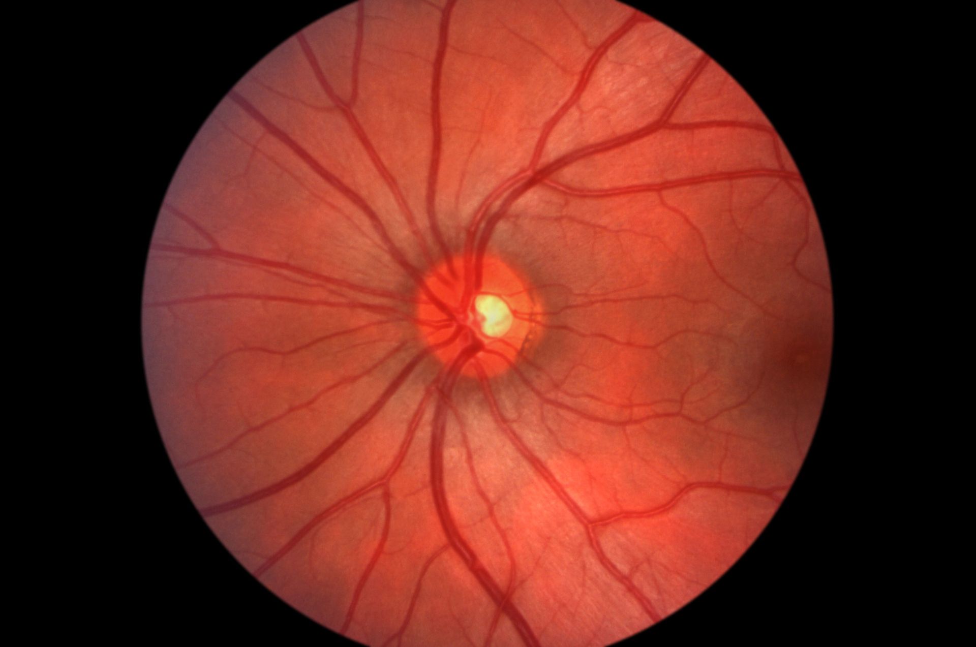 Nutrition And Macular Degeneration
