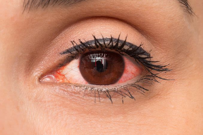 “MY EYES ARE RED – DO I HAVE COVID-19?”