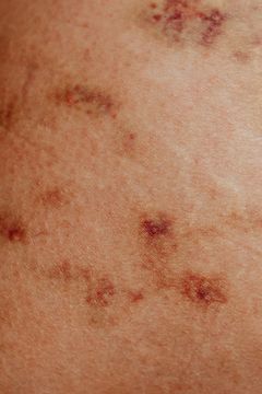 A close up of a person 's skin with red spots on it.