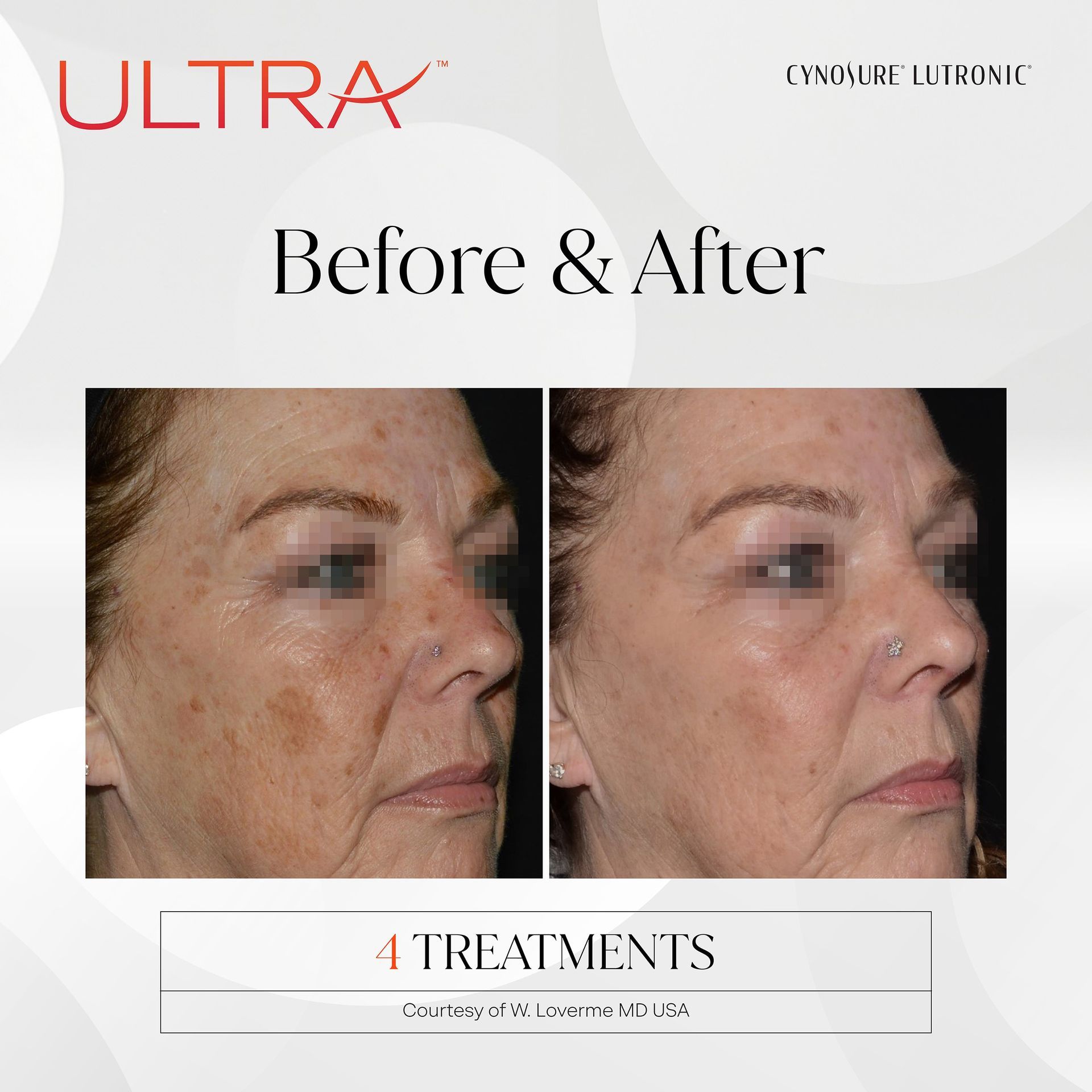 A before and after photo of a woman 's face