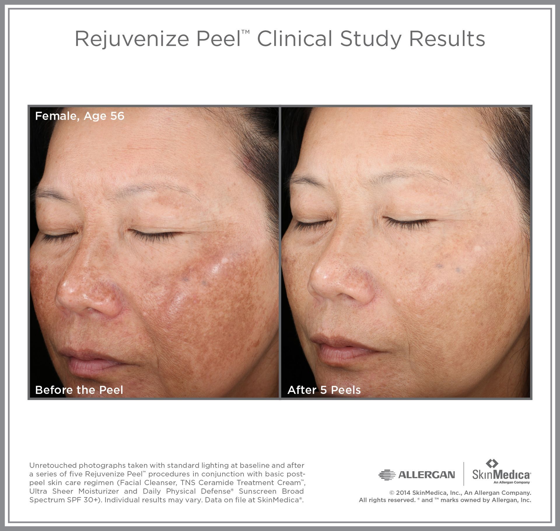 A picture of a woman 's face before and after a peel