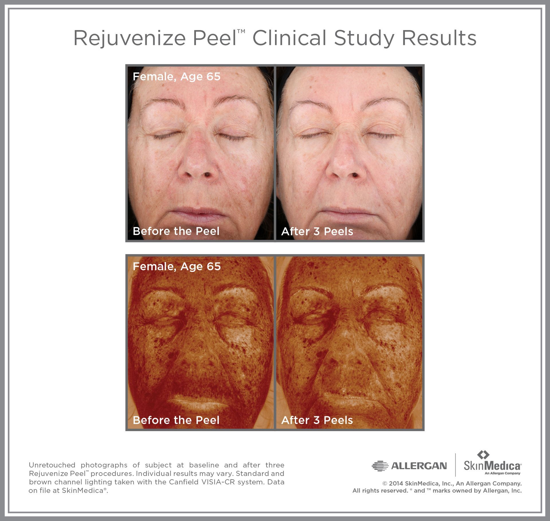 A picture of a woman 's face before and after the peel