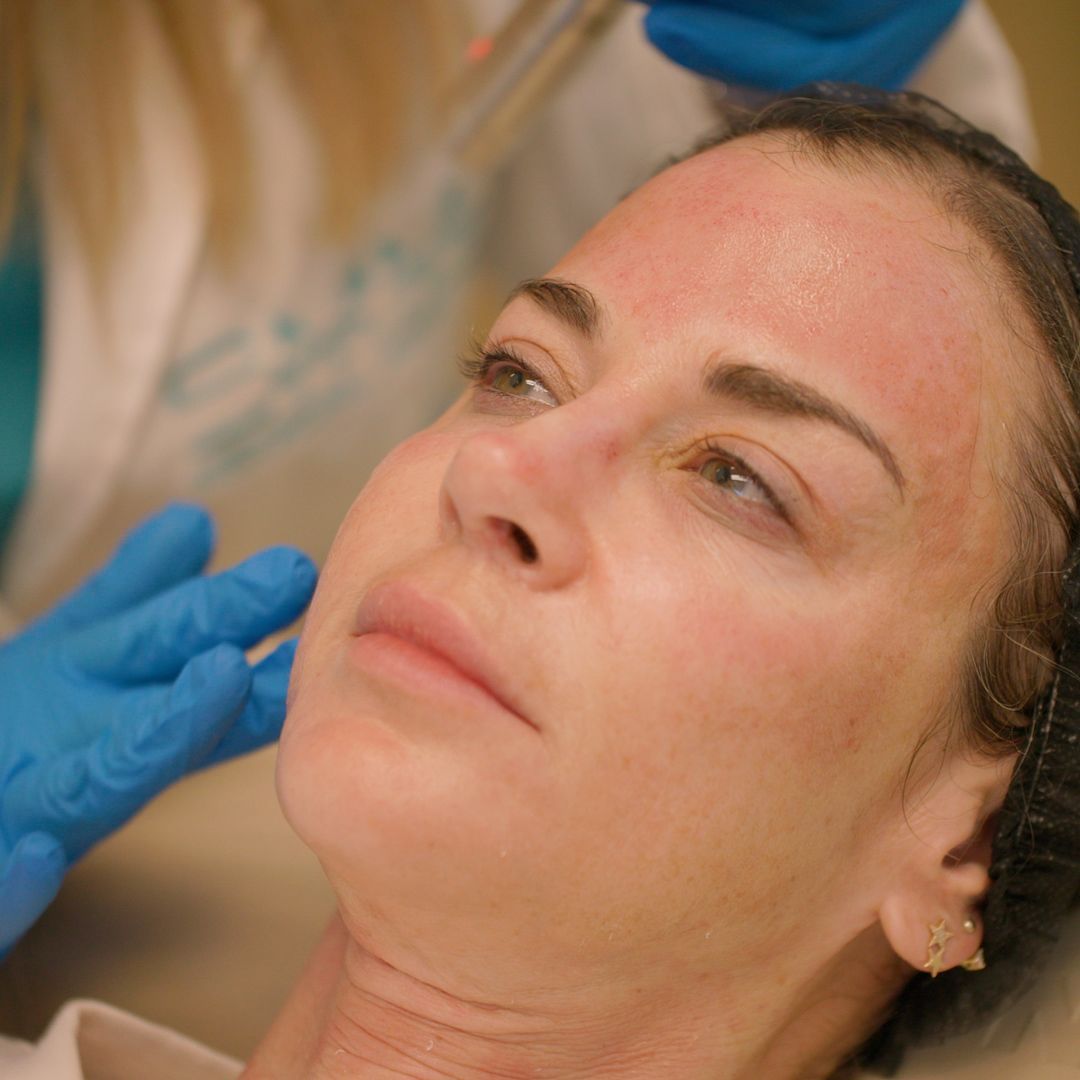 A woman is getting an injection in her face by a doctor wearing blue gloves.