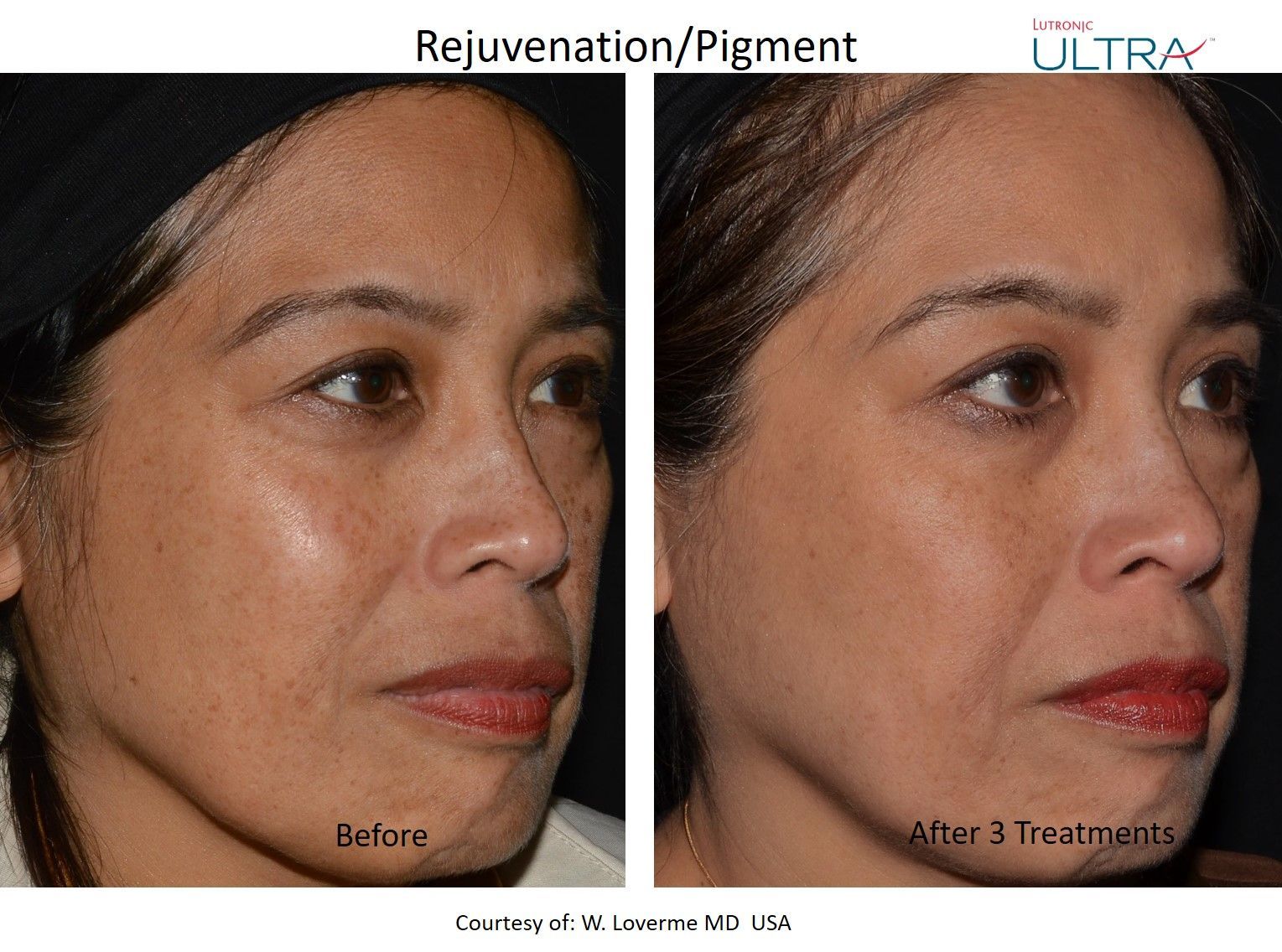 A before and after photo of a woman 's face.