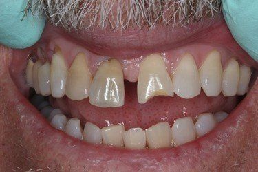 With Chipped — High Point, NC — High Point Smile Dentistry Dr. Paul Kwon and Associates