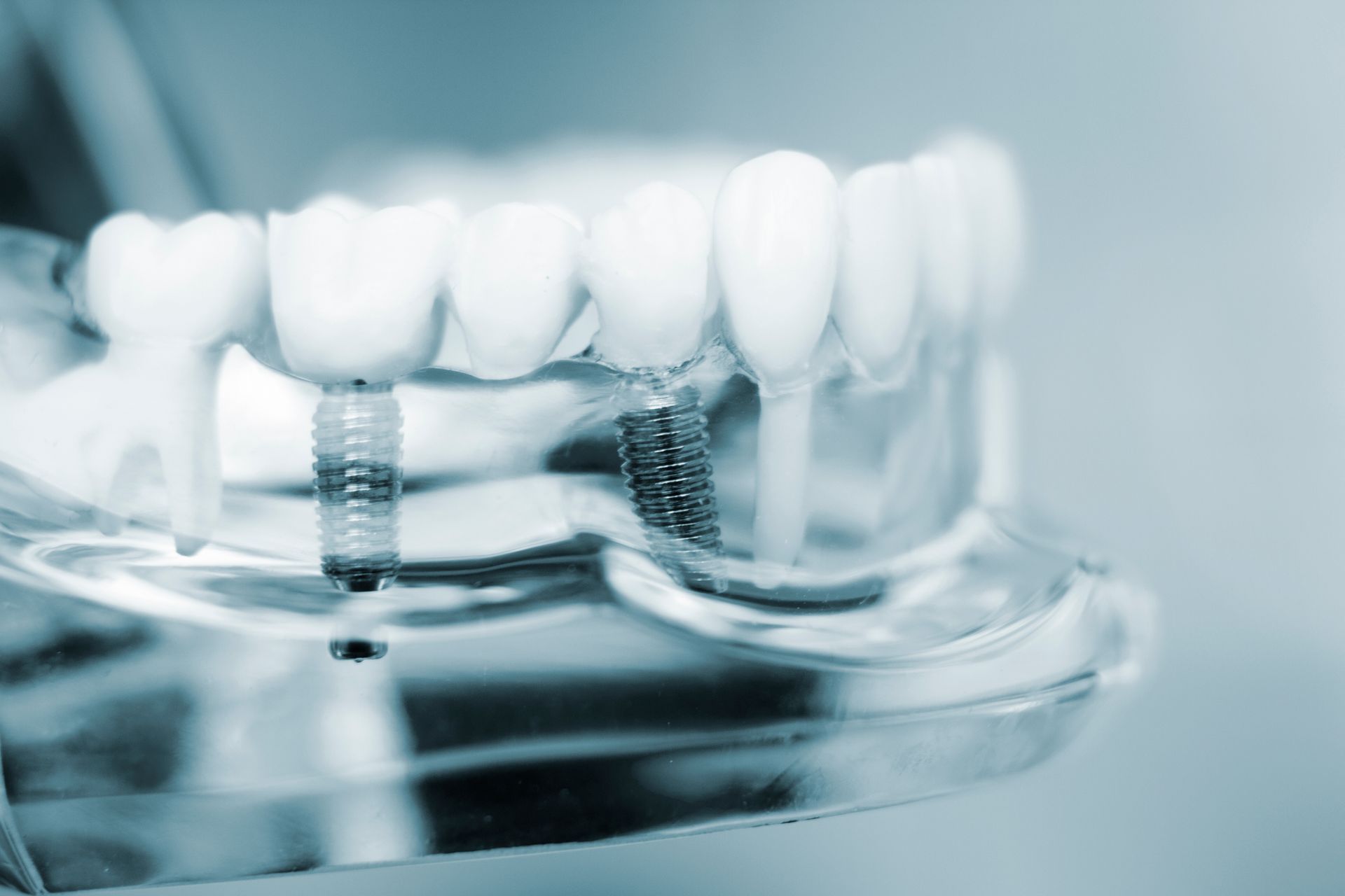 A dental model showing artificial teeth attached to metal implants in a clear jaw demonstration.