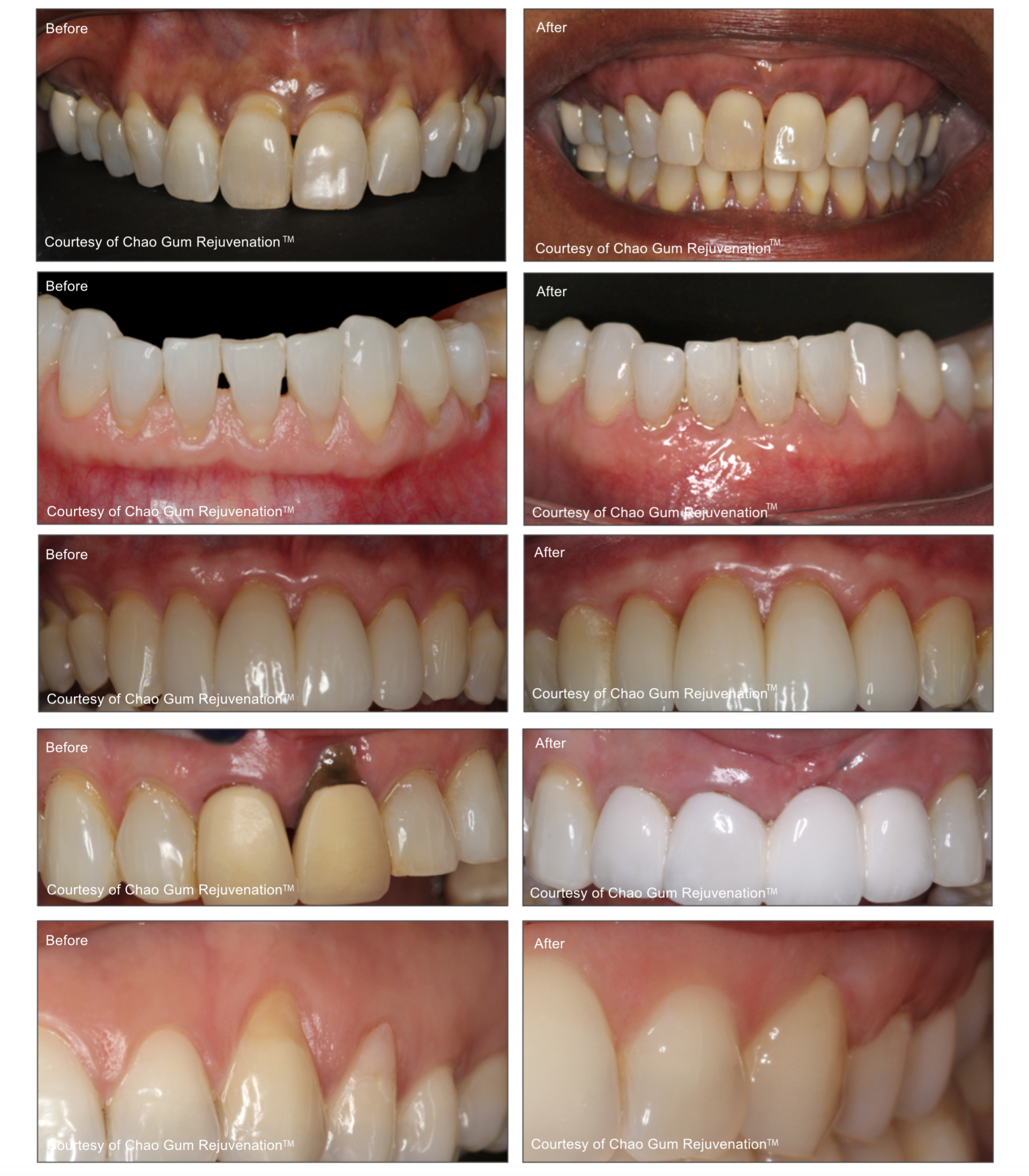 Before And After PST — High Point, NC — High Point Smile Dentistry Dr. Paul Kwon and Associates