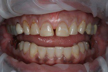 Performing Crown Before — High Point, NC — High Point Smile Dentistry Dr. Paul Kwon and Associates