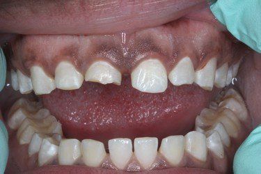 Broken Teeth Before — High Point, NC — High Point Smile Dentistry Dr. Paul Kwon and Associates