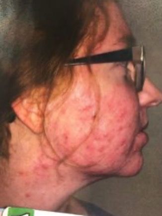 Acne patient before treatment