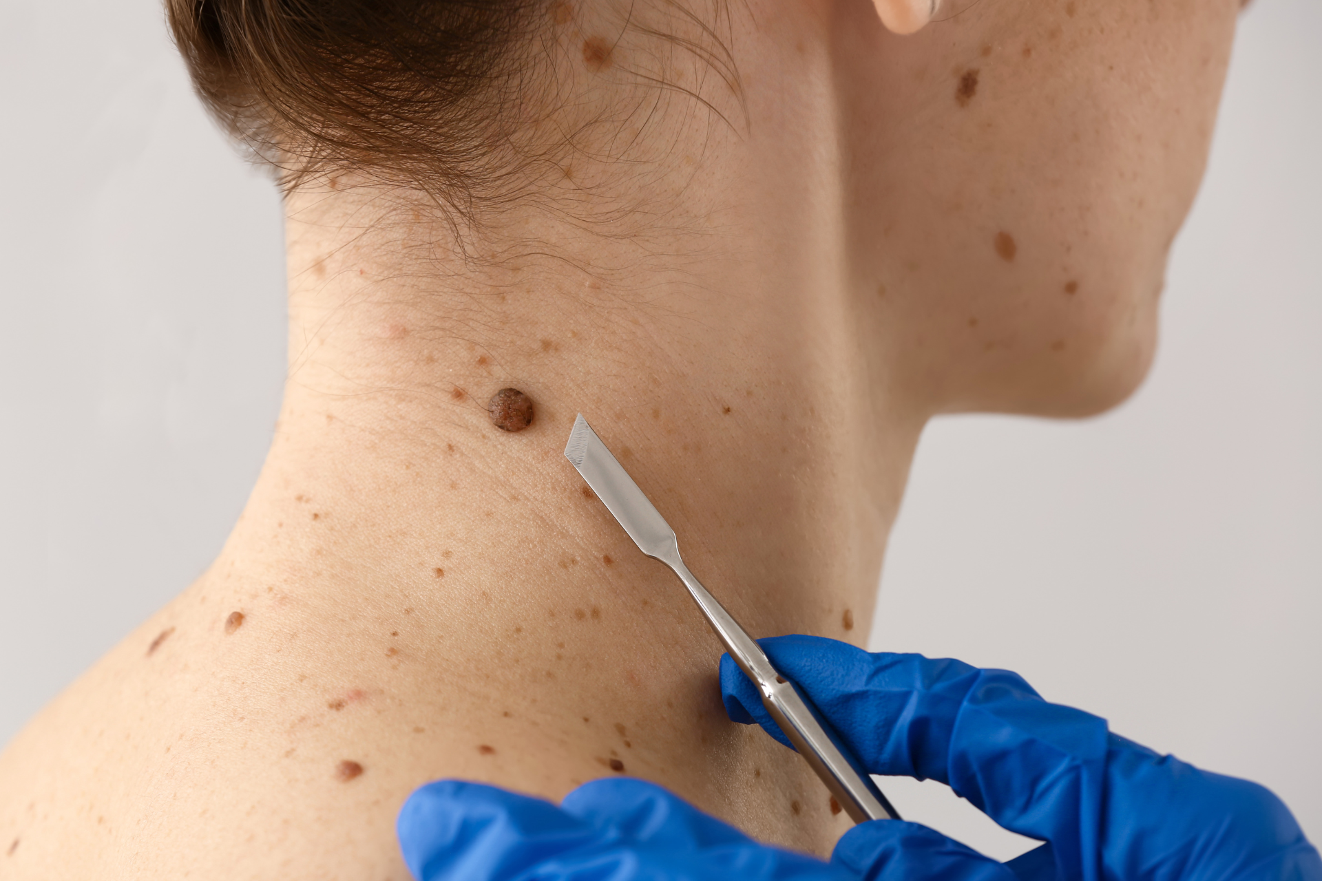 A woman is getting a mole removed from her neck.