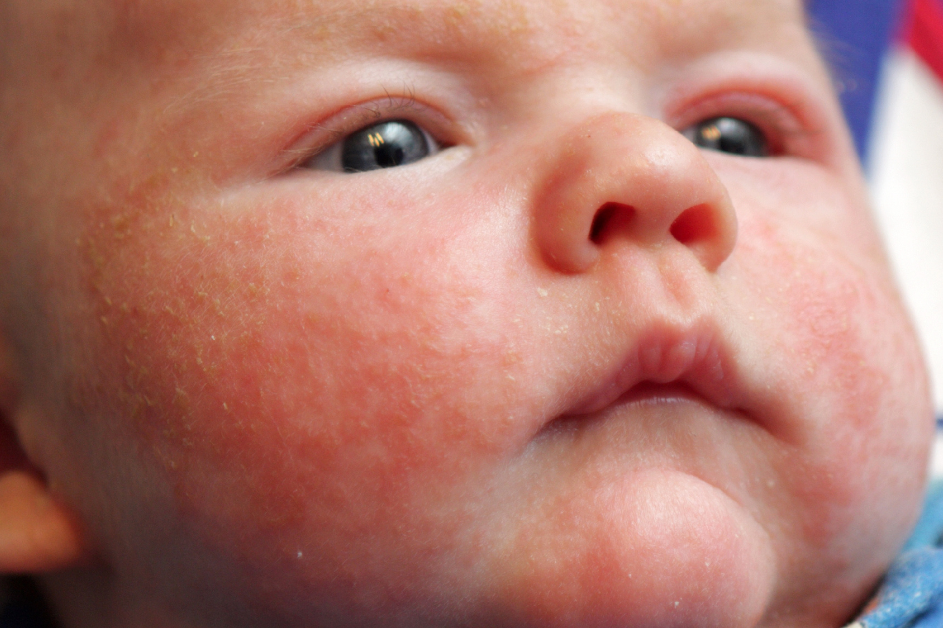 Child with Eczema