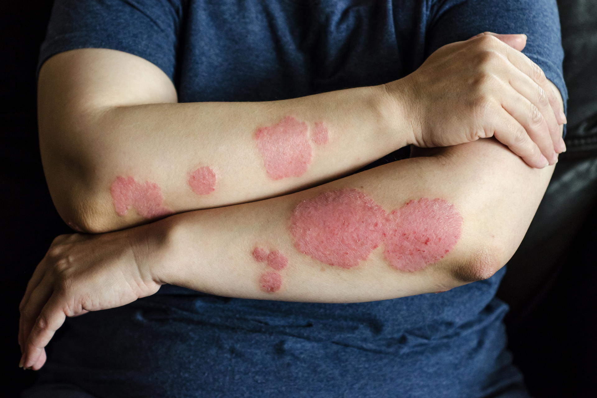 Dermatological skin disease. psoriasis, eczema, dermatitis, allergies. Skin lesions on the elbows.