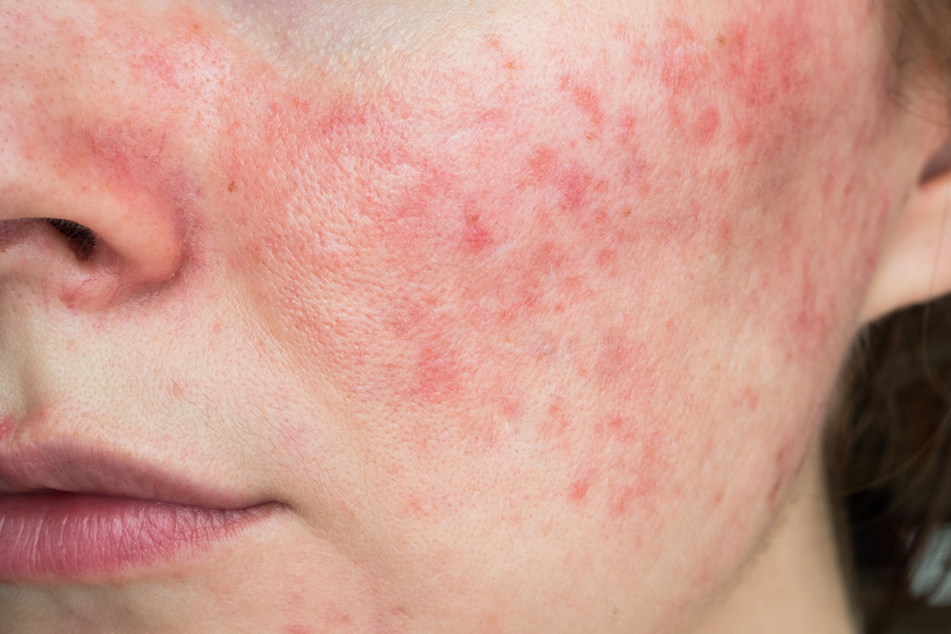 Rosacea