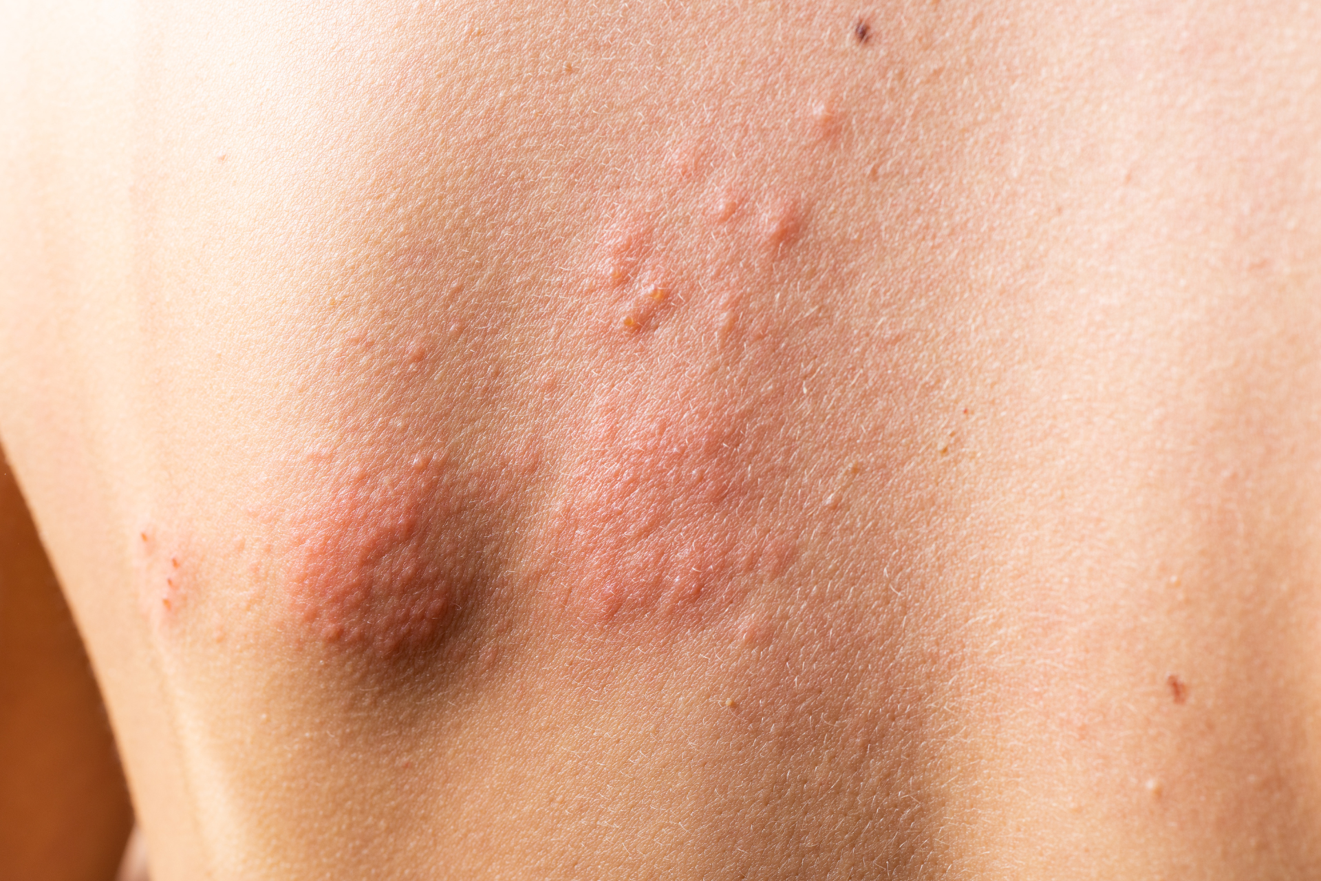 Skin Infections