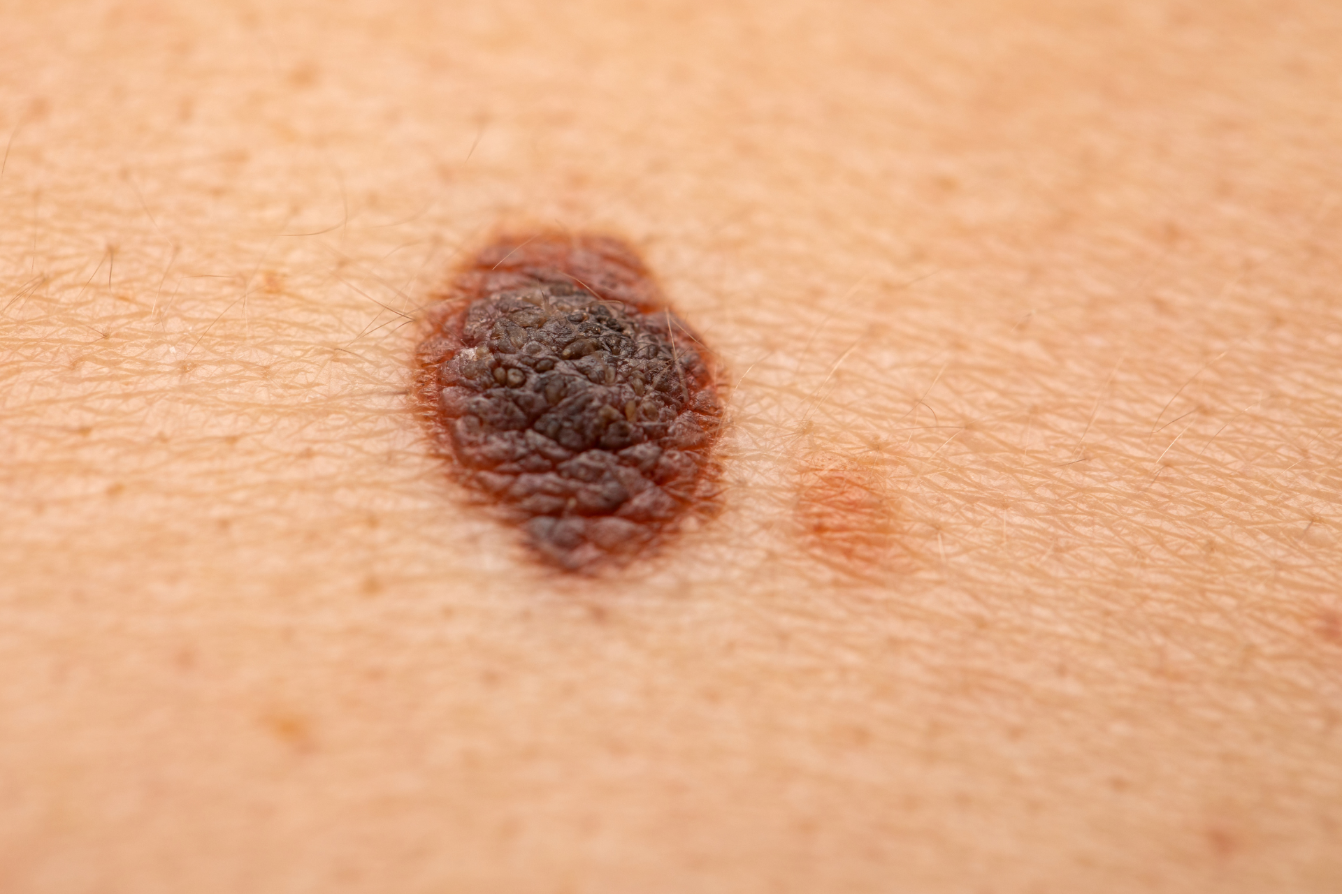 Melanoma