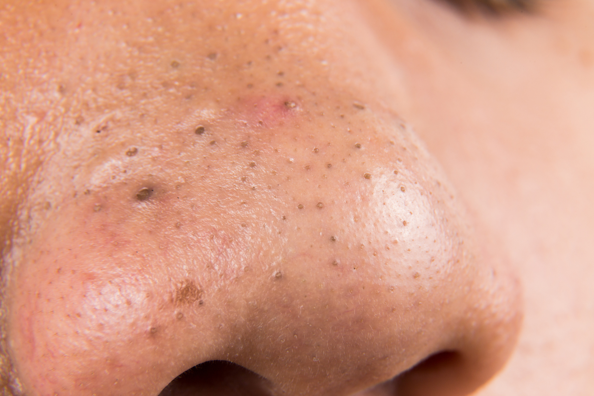 Blackheads