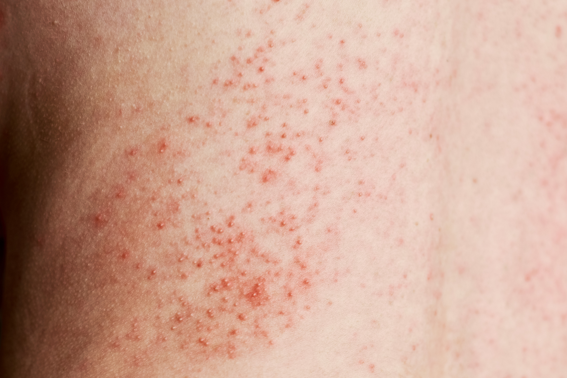 Skin Rashes