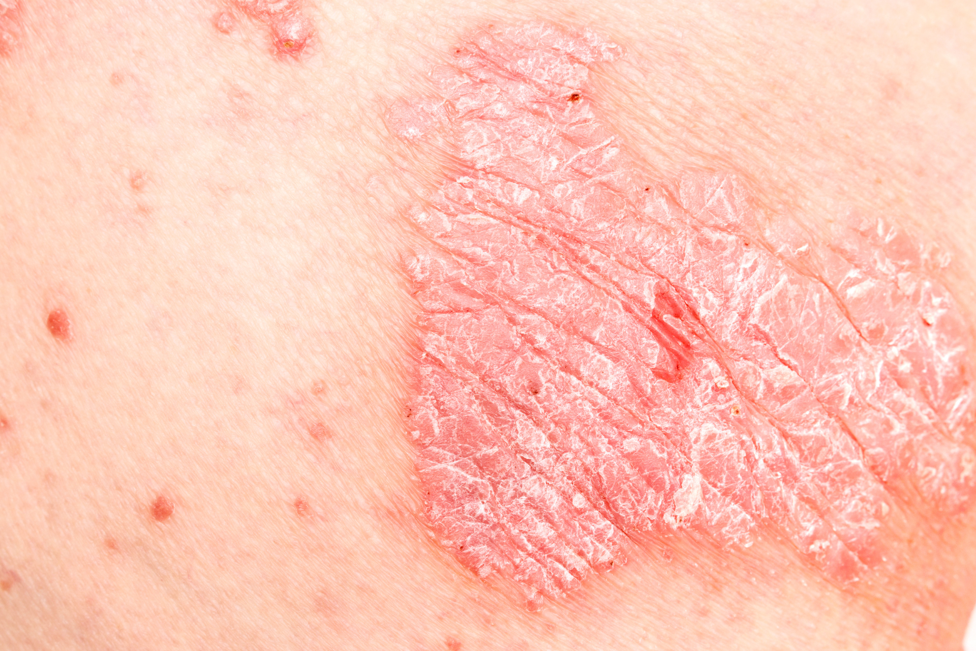  Psoriasis 